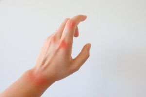 hand with pain points to show arthritis
